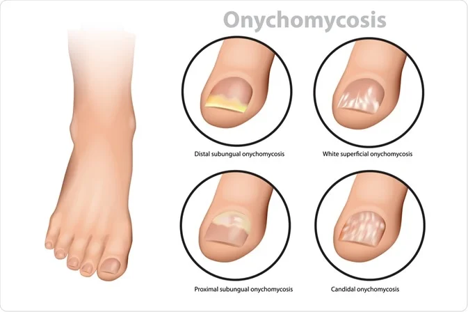 The Medical Truth About Nail Fungus: A Doctor's Perspective on Onychomycosis